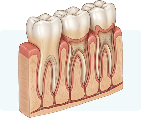 歯を守るために行う歯周病治療