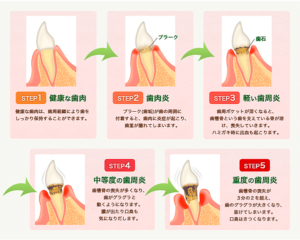 口臭が気になります。歯周病は治りますか?