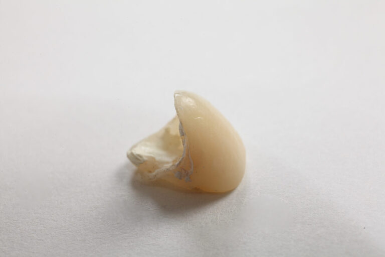 『奥歯が欠けた！応急処置や歯科医院での治療法』