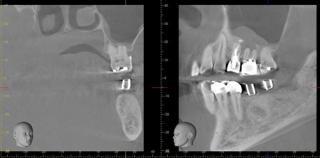 インプラント治療の術前シミュレーションに使用された歯科用CBCT画像。骨量や周囲組織の状態を立体的に評価。