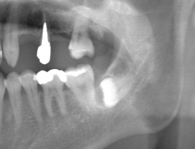 埋伏歯の位置を確認できるパノラマレントゲン画像。親知らずが骨の中に水平に埋まっている様子が見られる。