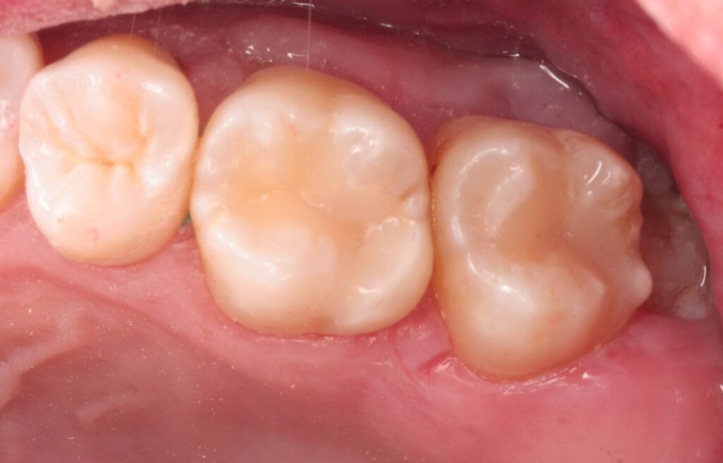 コンポジットレジン（CR）