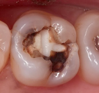 痛みがなくても進行するむし歯