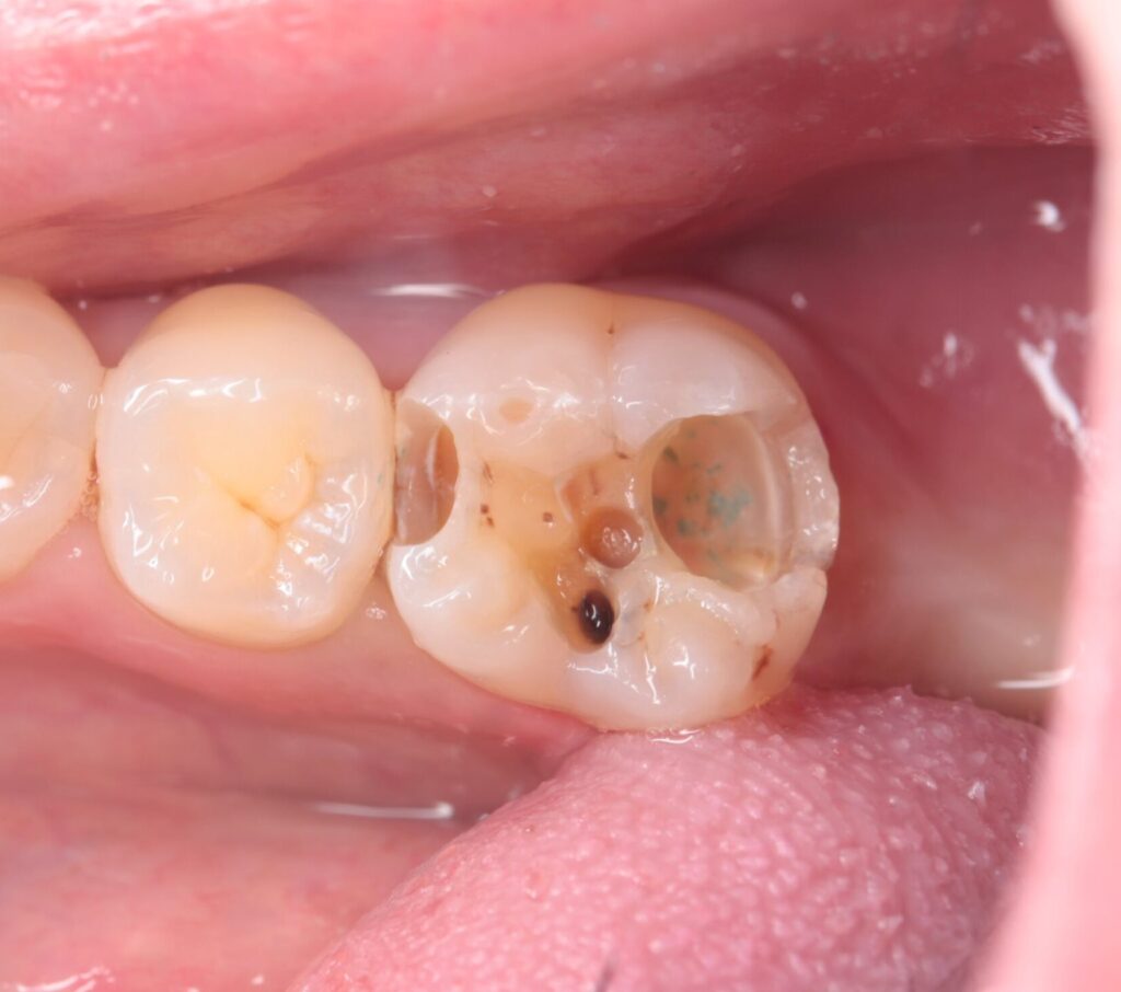 神経に達したむし歯