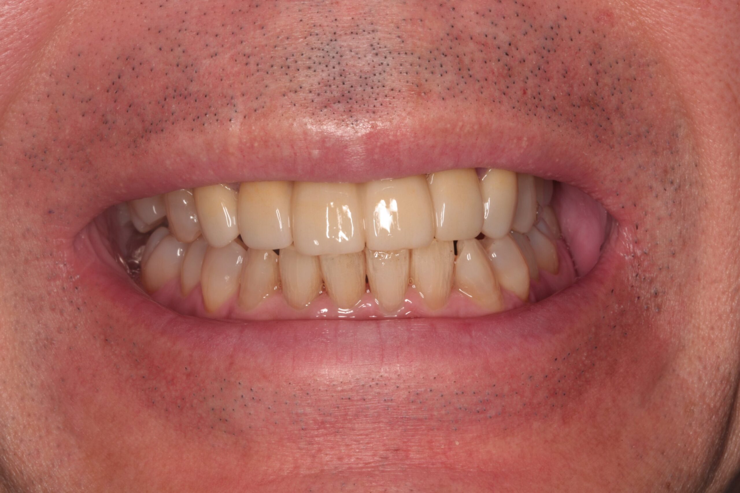 装着後1年半経過