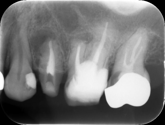 根の治療完了時レントゲン