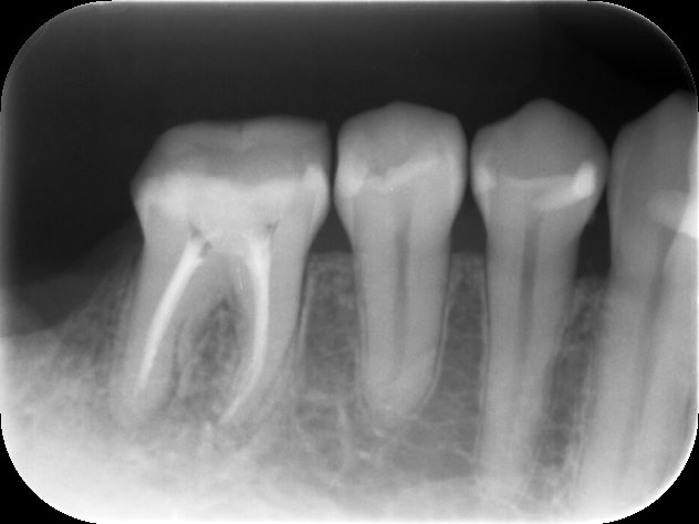 神経の治療完了時のレントゲン
