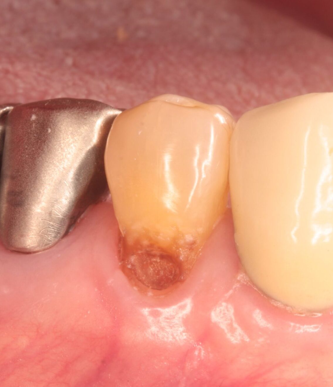 なぜ「歯の根っこ」は虫歯になりやすく、進行が早いのか?