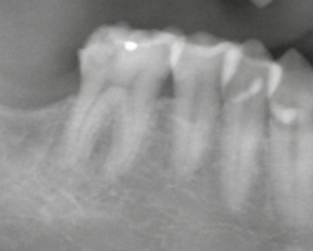 治療前レントゲン