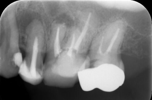 治療前レントゲン