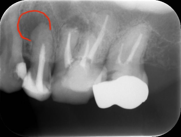 術前レントゲン