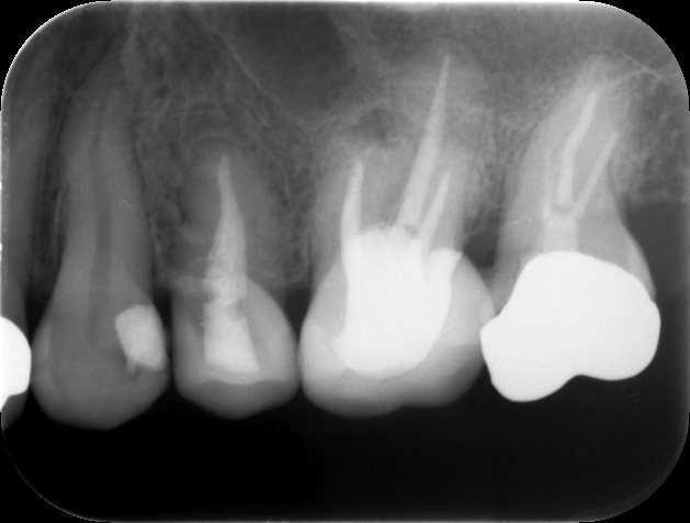 治療後レントゲン