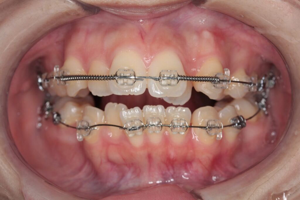 固定式矯正（ワイヤー矯正）